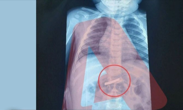 Αγωνία για αγοράκι τριών ετών - Κατάπιε ξυραφάκι