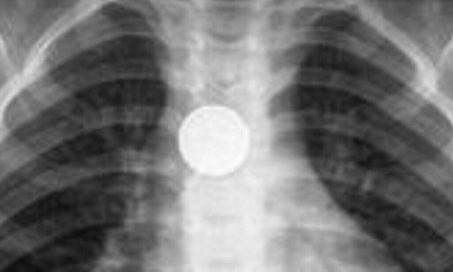 Τέλος καλό για το τρίχρονο που κατάπιε ξυραφάκι - Από καπάκια μέχρι παραμάνες «δοκιμάζουν» τα παιδιά