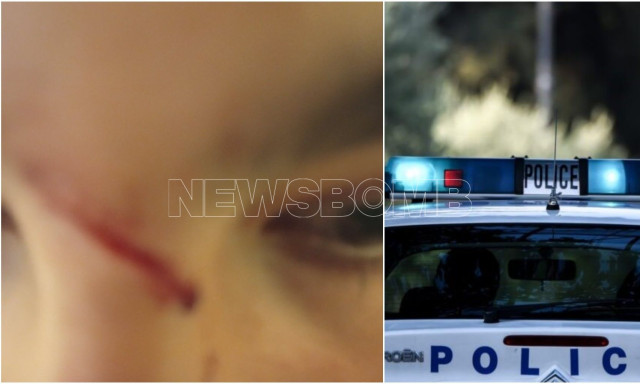 Αχαρνές: 16χρονος αντιστάθηκε σε ληστεία και τον χάραξαν με φαλτσέτα - «Φοβάται», λέει ο πατέρας του