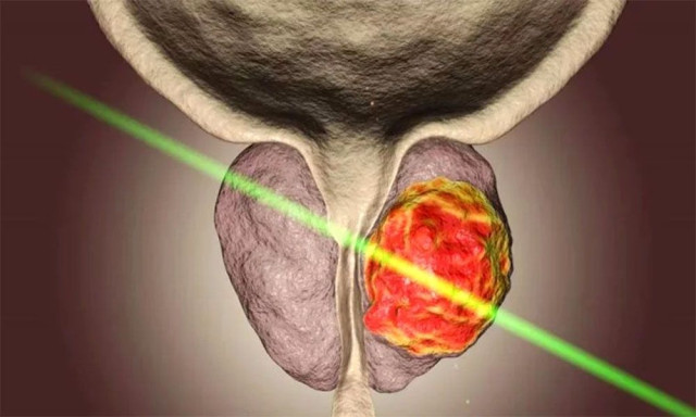 Υπερπλασία Προστάτη; Η τεχνολογία Laser δίνει τη λύση