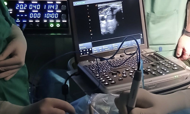 Συρρίκνωση όζων θυρεοειδούς με μικροκύματα - Για πρώτη φορά στο ΕΣΥ η ελάχιστα επεμβατική μέθοδος