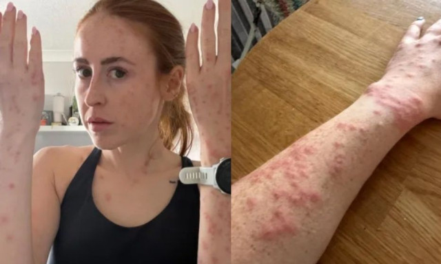 Influencer γέμισε με σημάδια από τσιμπήματα κοριών σε όλο της το κορμί - «Έπαθα κρίση πανικού»