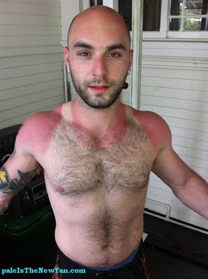 Τα χειρότερα καλοκαιρινά μαυρίσματα που έχετε δει! (pics)