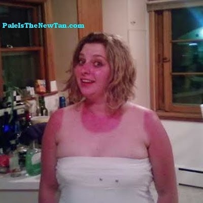 Τα χειρότερα καλοκαιρινά μαυρίσματα που έχετε δει! (pics)