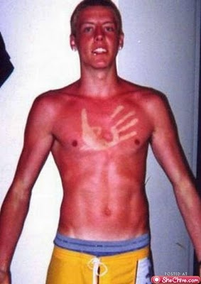 Τα χειρότερα καλοκαιρινά μαυρίσματα που έχετε δει! (pics)