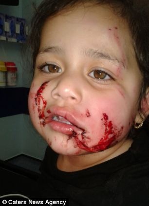 Σκληρές εικόνες: Σκύλος επιτέθηκε σε 2χρονη την ώρα που εκείνη έπαιζε 