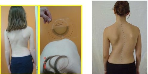 Σκολίωση: Συχνή στα κορίτσια. Αναγνωρίστε την και λύστε το πρόβλημα