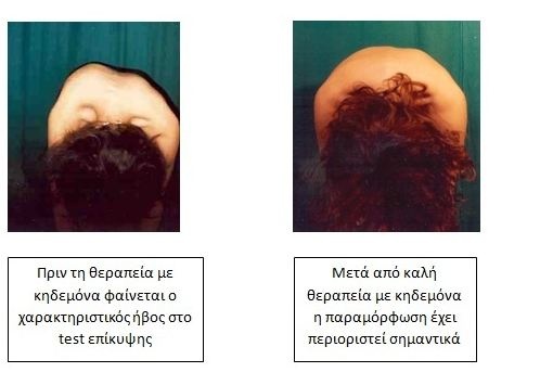 Σκολίωση: Συχνή στα κορίτσια. Αναγνωρίστε την και λύστε το πρόβλημα