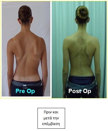 Σκολίωση: Συχνή στα κορίτσια. Αναγνωρίστε την και λύστε το πρόβλημα