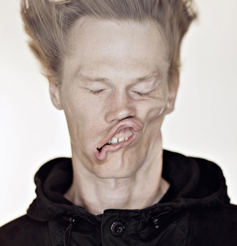 Δείτε από τι παραμορφώθηκε το πρόσωπό τους! (pics)