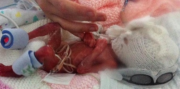 Συγκλονιστικό: Πρόωρο μωρό 23 εβδομάδων σώθηκε χάρη σε ένα ψαλίδι!