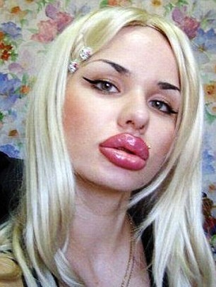 Δείτε πώς έγινε αυτό το όμορφο κορίτσι μετά από ενέσεις σιλικόνης