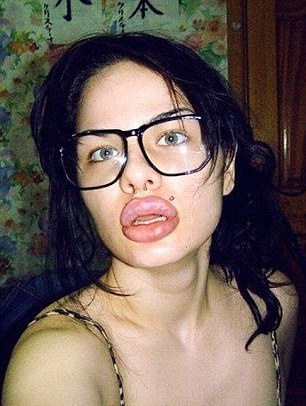 Δείτε πώς έγινε αυτό το όμορφο κορίτσι μετά από ενέσεις σιλικόνης