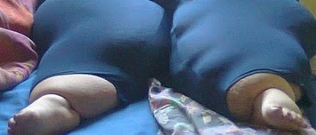 ΣΟΚ: Δείτε πως έγιναν τα πόδια της από το τσίμπημα ενός κουνουπιού!