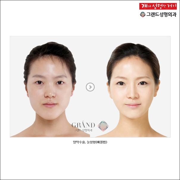 Απίστευτες φωτογραφίες ανθρώπων πριν και μετά την πλαστική 