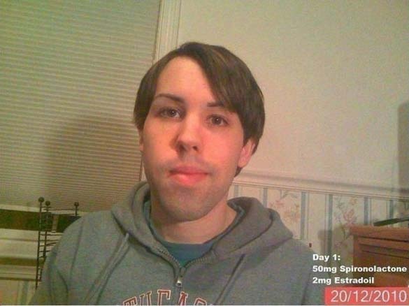 Έπαιρνε θηλυκές ορμόνες για 14 μήνες! Δείτε πως έγινε 