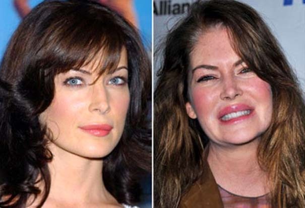 Διάσημοι πριν και μετά τις πλαστικές επεμβάσεις (pics)