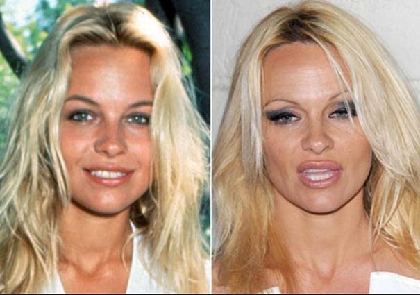 Διάσημοι πριν και μετά τις πλαστικές επεμβάσεις (pics)