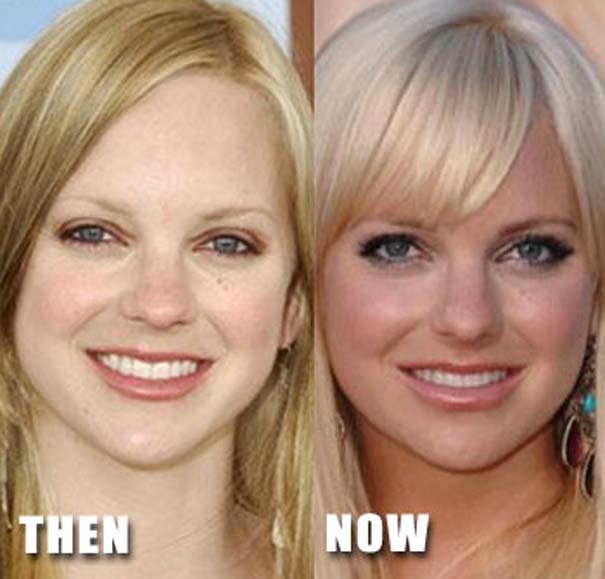 Διάσημοι πριν και μετά τις πλαστικές επεμβάσεις (pics)