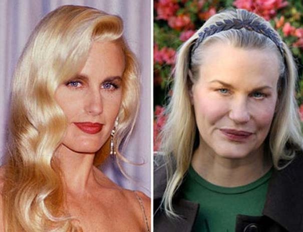 Διάσημοι πριν και μετά τις πλαστικές επεμβάσεις (pics)