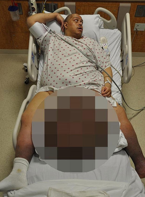 ΣΟΚ: Αφαίρεσε όρχι βάρους 45 κιλών!