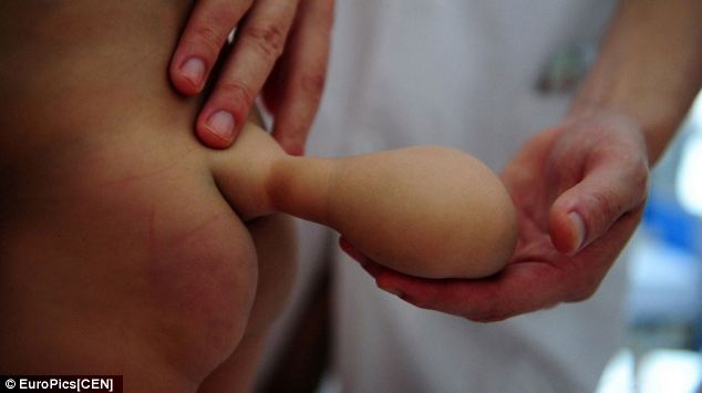 ΣΟΚ: Γεννήθηκε μωρό με... ουρά! (pics)