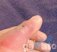 Δείτε πώς έγινε 9 μέρες αφού τον δάγκωσε αράχνη!