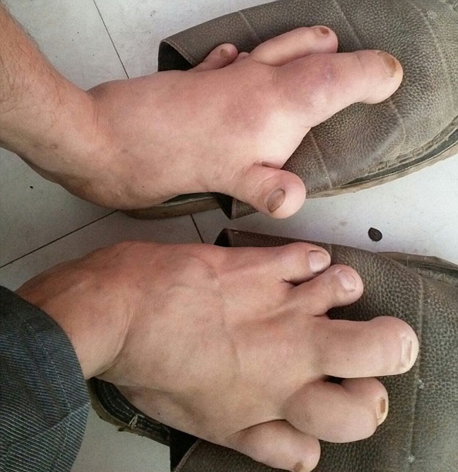 Έβαλε παπούτσια στα 27 του πρώτη φορά λόγω ελεφαντίασης 