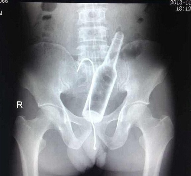 ΣΟΚ: Έμειναν άναυδοι όταν βρήκαν ένα μπουκάλι και ένα αγκίστρι στον...