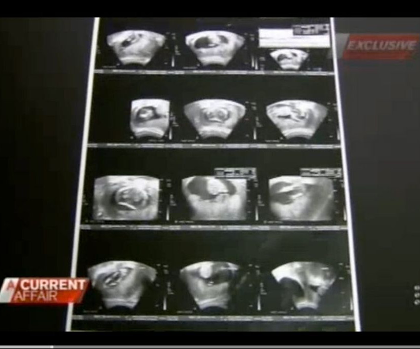 «Πάγωσε» όταν οι γιατροί της είπαν ότι κυοφορεί μωρό που έχει...