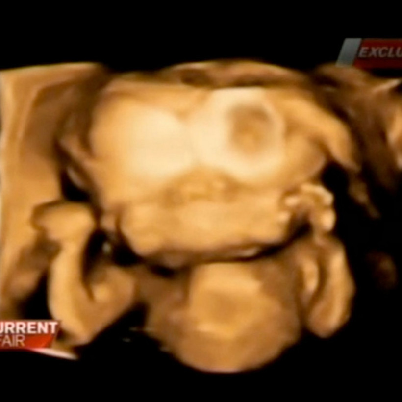 «Πάγωσε» όταν οι γιατροί της είπαν ότι κυοφορεί μωρό που έχει...