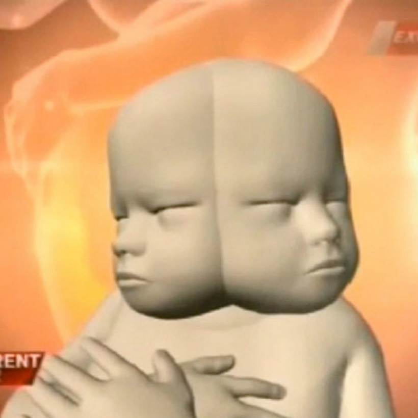 «Πάγωσε» όταν οι γιατροί της είπαν ότι κυοφορεί μωρό που έχει...