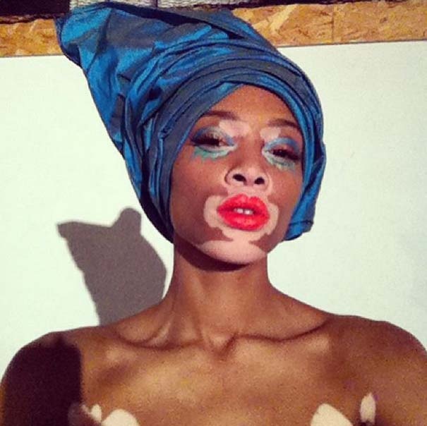Winnie Harlow: Το μοντέλο που έκανε την πάθηση της, σπάνιο προσόν(pic)