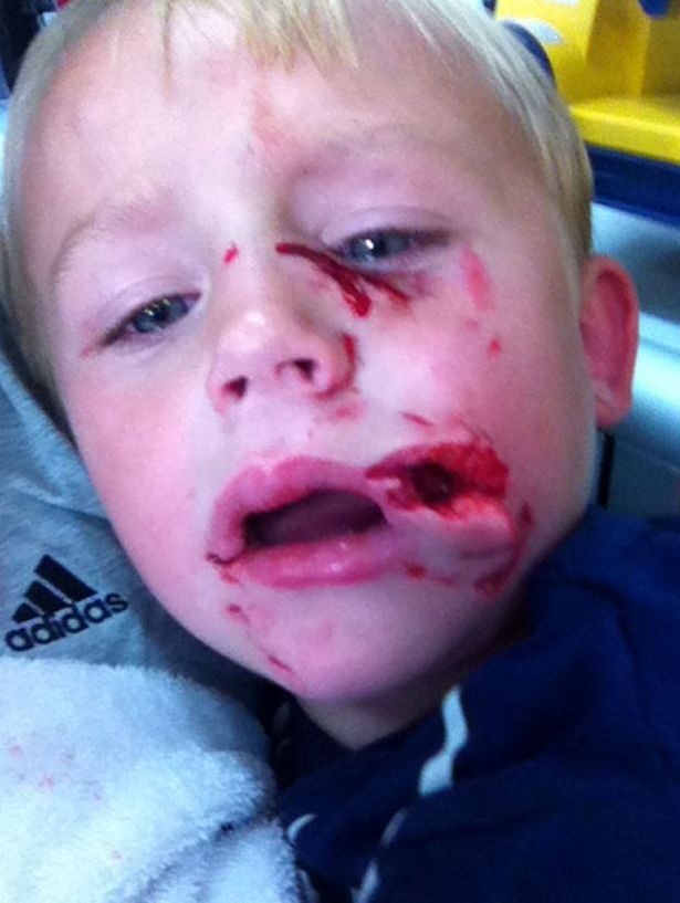 Φρίκη! Σκύλος επιτέθηκε σε παιδί (σκληρές εικόνες)