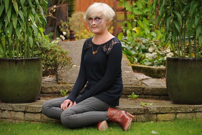 Βρετανία: Οι σοκαριστικές selfies – μήνυμα κατά του καρκίνου! (photos)