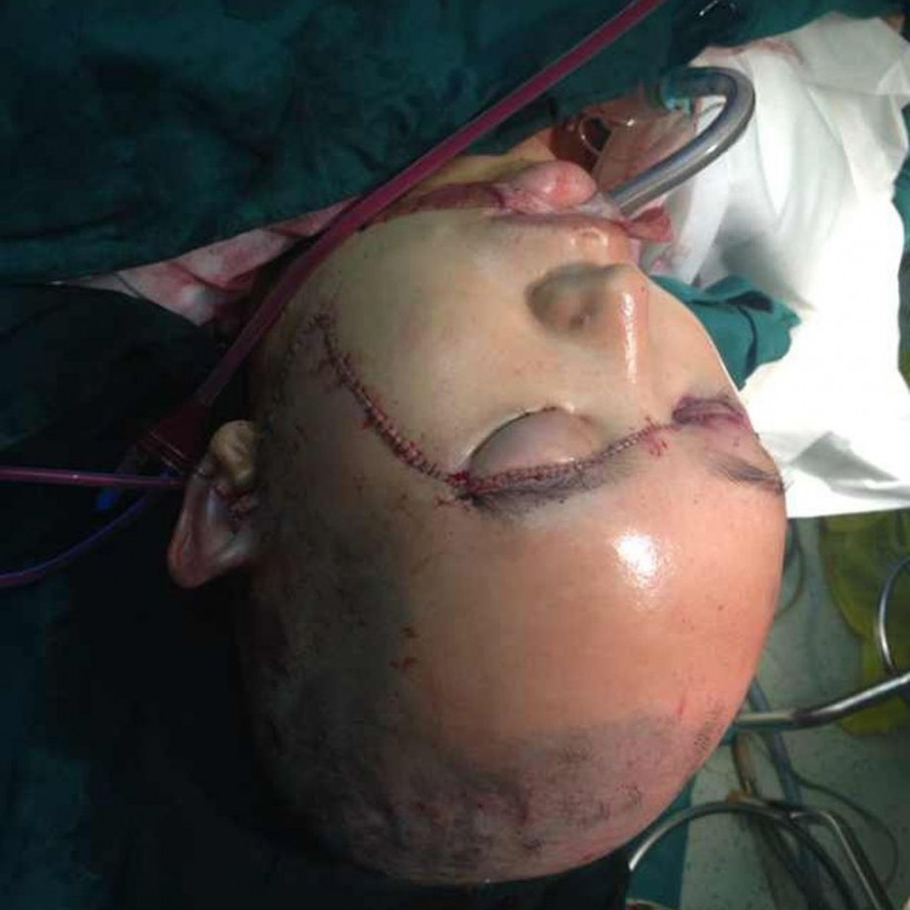 Σκληρές εικόνες: Της έφυγε ολόκληρο το δέρμα από το κεφάλι 