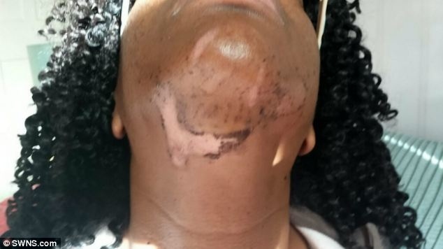 Σημαδεύτηκε για μια ζωή μετά από αποτρίχωση! (σκληρές εικόνες)