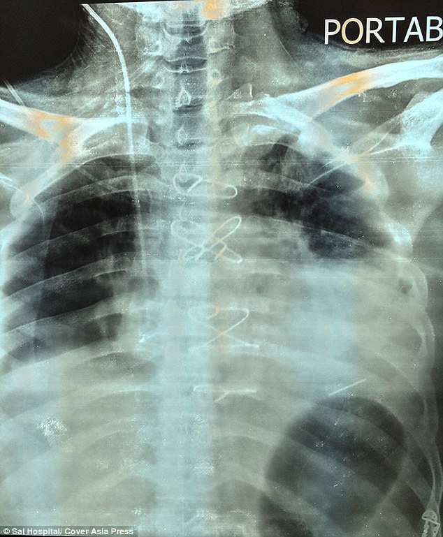 Απίστευτο: Ζούσε με μια σφαίρα στην καρδιά του επί δύο μήνες