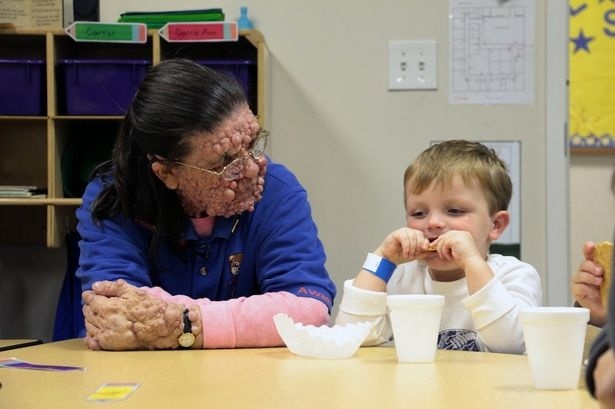 Τραγικό: Το πρόσωπο της είναι γεμάτο φουσκάλες (σκληρές εικόνες)