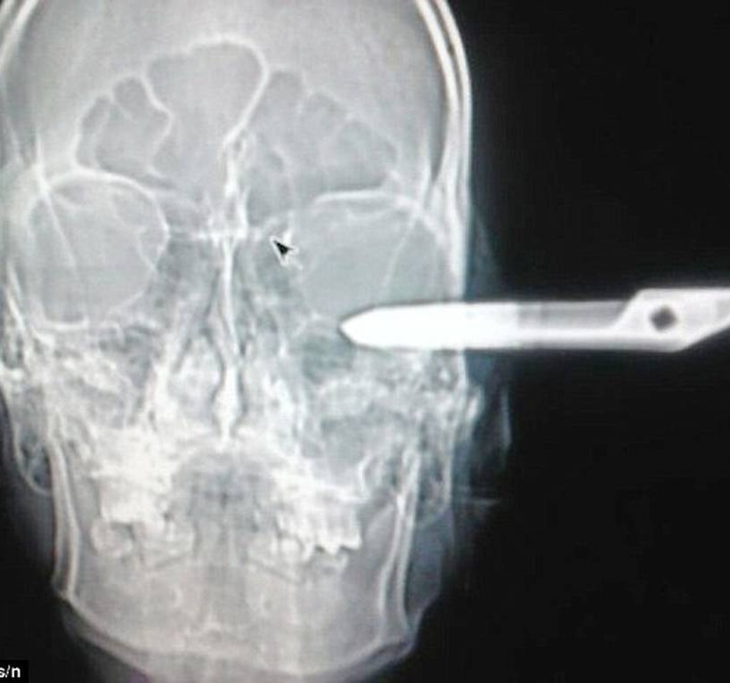 Βραζιλία: Πήγε στα επείγοντα με καρφωμένο ένα ψαλίδι στο κεφάλι του (pics)