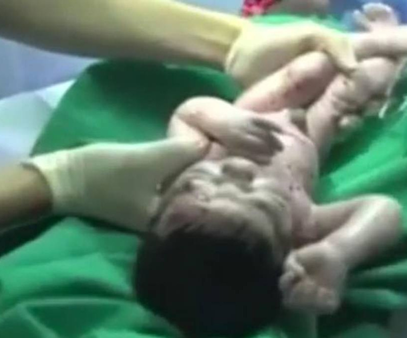 Συγκλονιστικό: Μωρό γεννήθηκε με θραύσματα στο κεφάλι μετά από έκρηξη βόμβας (video)