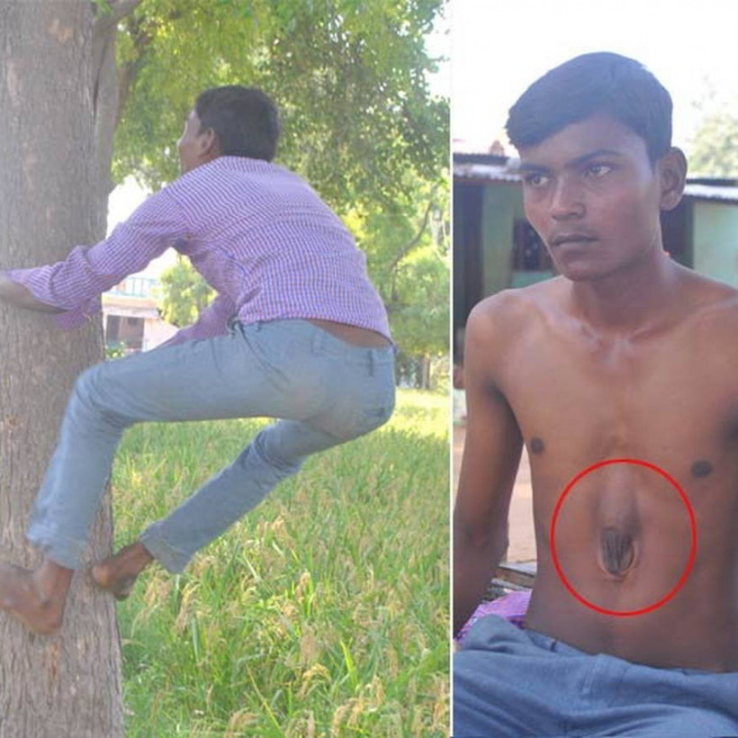 Ιατρικό θαύμα: Ο άνθρωπος που ζει με την καρδιά έξω από το στήθος! (video)