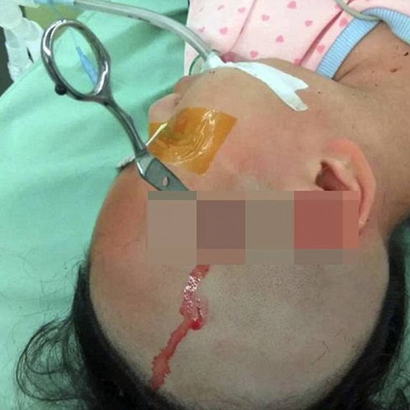 Πατέρας κάρφωσε ψαλίδι στο κεφάλι της κόρης του επειδή δεν διάβαζε! (ΠΡΟΣΟΧΗ ΣΚΛΗΡΕΣ ΕΙΚΟΝΕΣ)