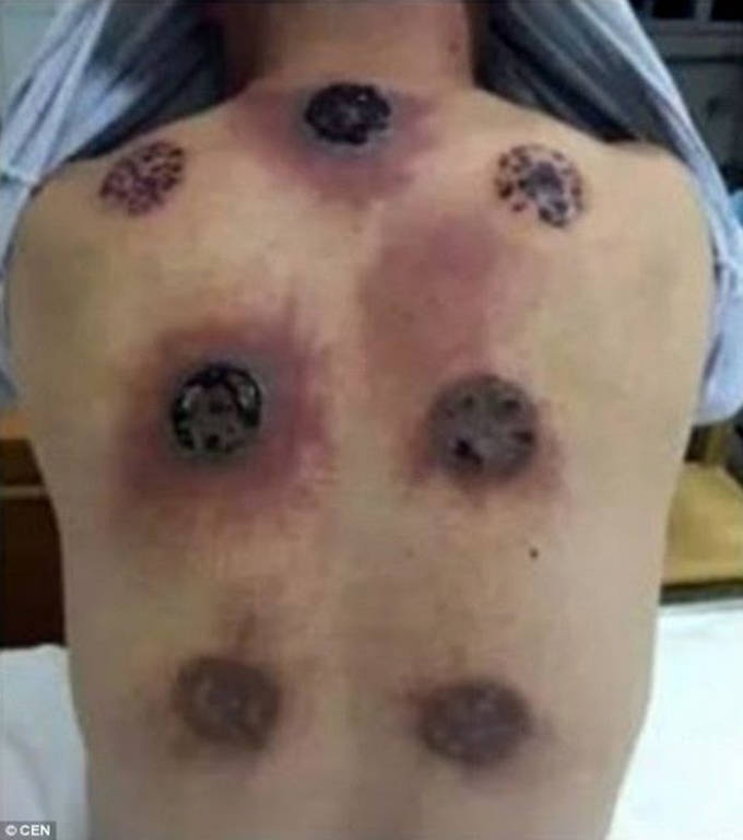 Η πλάτη του πρήστηκε και τεράστιες γέμισε τρύπες - Δεν φαντάζεστε από τι.... (Σκληρές εικόνες)