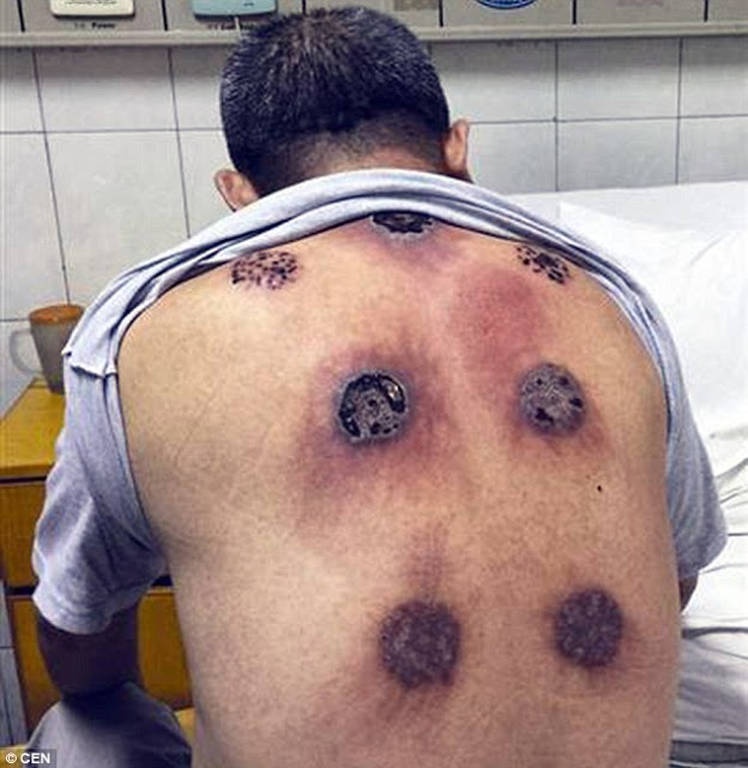 Η πλάτη του πρήστηκε και τεράστιες γέμισε τρύπες - Δεν φαντάζεστε από τι.... (Σκληρές εικόνες)