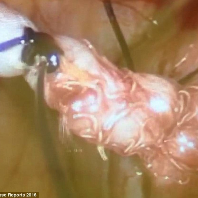 Παραπονιόταν για φρικτούς πόνους στην κοιλιά: Δεν φαντάζεστε τι βρήκαν μέσα της οι γιατροί (vid)