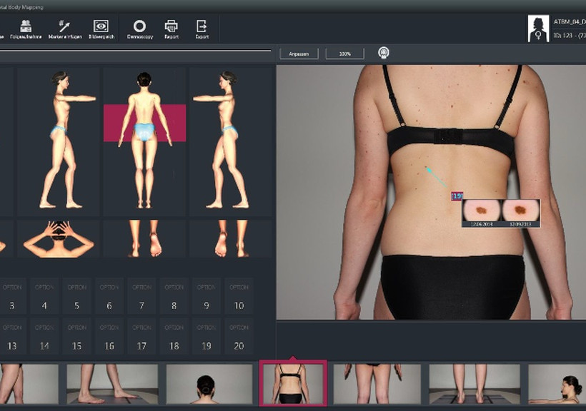 Σπίλοι(Ελιές): Προσοχή στην άσκοπη αφαίρεση