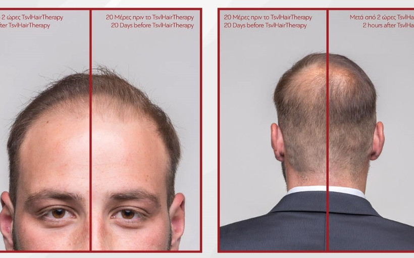 Έλληνας εξαλείφει την αραίωση των μαλλιών σε δύο ώρες