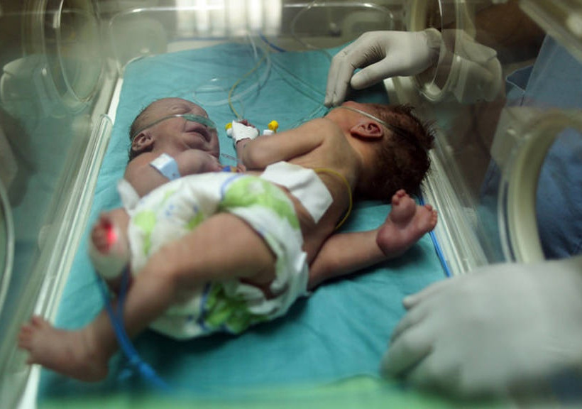 Συγκίνηση για τα σιαμαία κοριτσάκια που διαχωρίστηκαν έπειτα από τρεις μήνες ζωής (Pics)