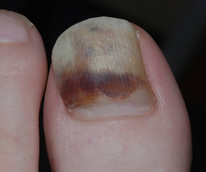 Προσοχή: Τι πρέπει να κάνετε αν δείτε αυτές τις γραμμές στα νύχια σας!
